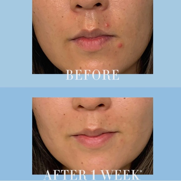 Kate Somerville EradiKate Acne Mark Fading Gel with Salicylic Acid New - Picture 7 of 13